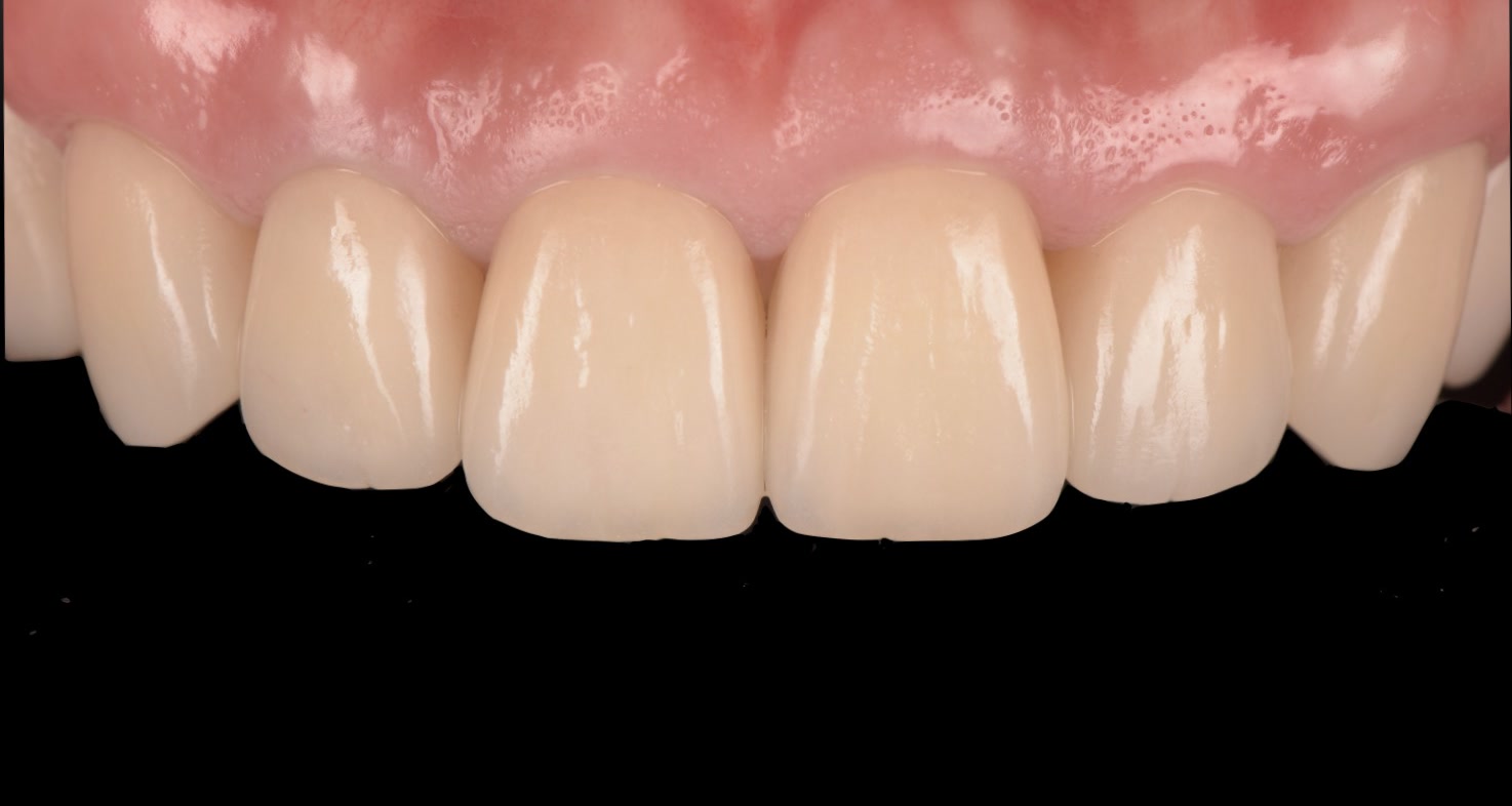 LECTURE 2 症例：前歯部審美のクラウン