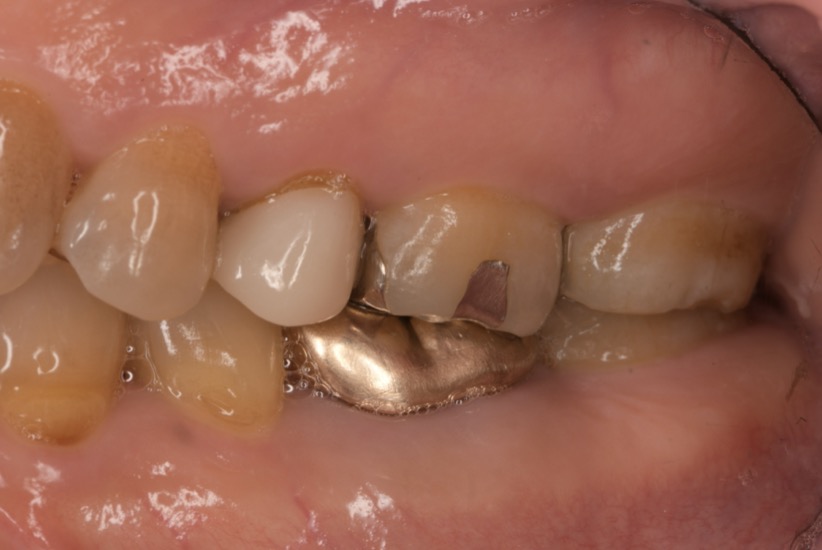 LECTURE 1 症例：前歯部クローズアップ